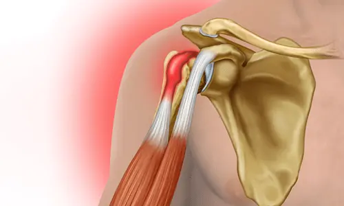 Was ist eine Bizeps-Tendinitis?