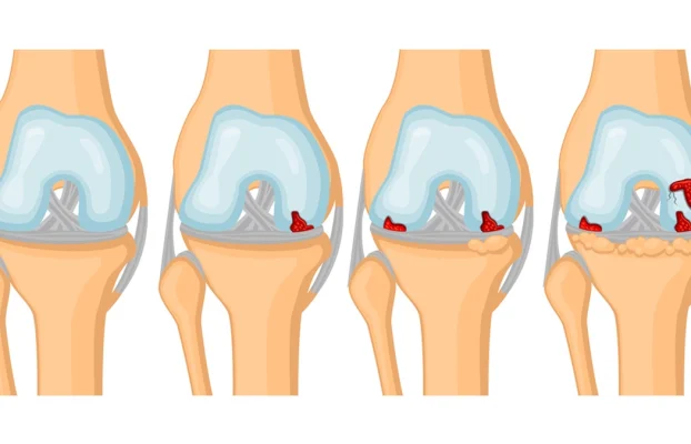 Kniearthrose: Ursachen, Symptome und Behandlung in Wien