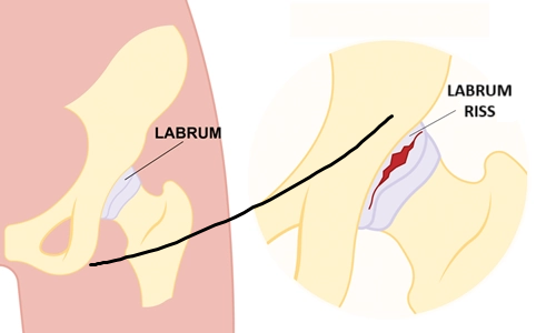 Was ist ein Labrumriss? Behandlung und Operation eines Labrumrisses