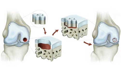 Mosaikplastik (Knorpeltransplantation): Was ist das und wie wird es durchgeführt?