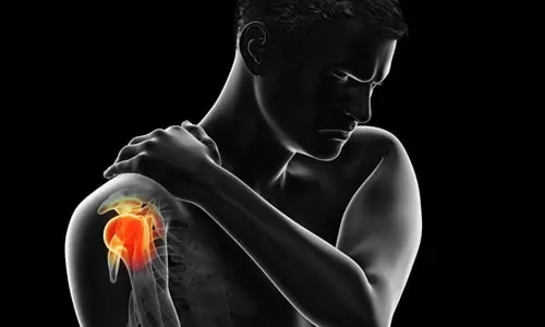 Schulterimpingement-Syndrom: Symptome und Operation