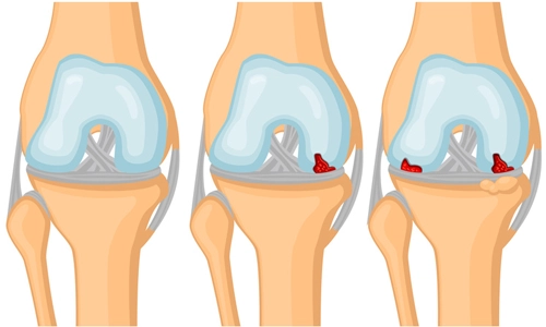 Was ist Kniearthrose? Behandlung und Operation von Gonarthrose