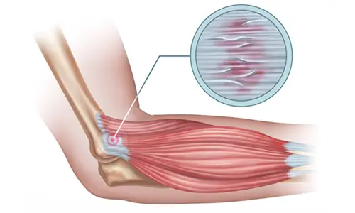 Tennisarm: Ursachen, Symptome und effektive Behandlung