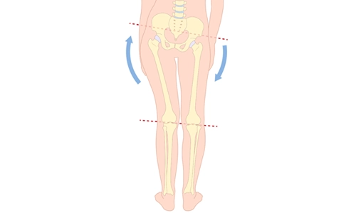 Beinlängendifferenz: Ursachen, Symptome und Behandlung