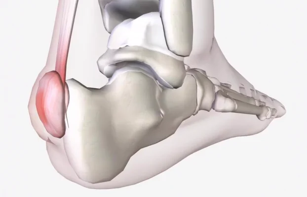 Haglund-Deformität: Ursachen, Symptome und Behandlung