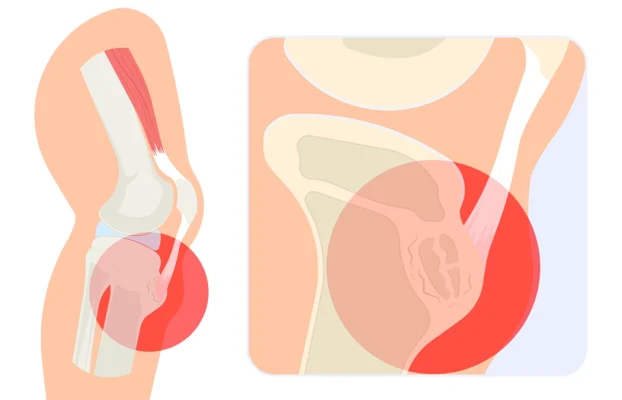 Osgood-Schlatter-Krankheit: Ursachen, Symptome & Behandlung