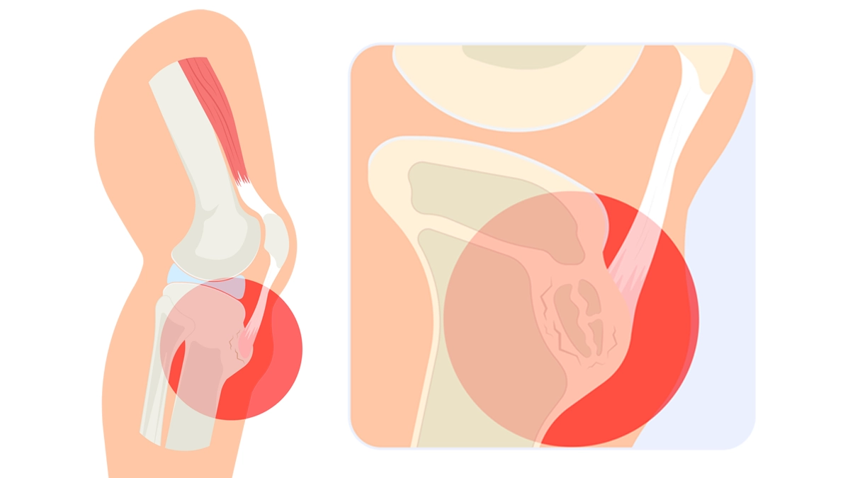 Osgood-Schlatter-Krankheit: Ursachen, Symptome & Behandlung