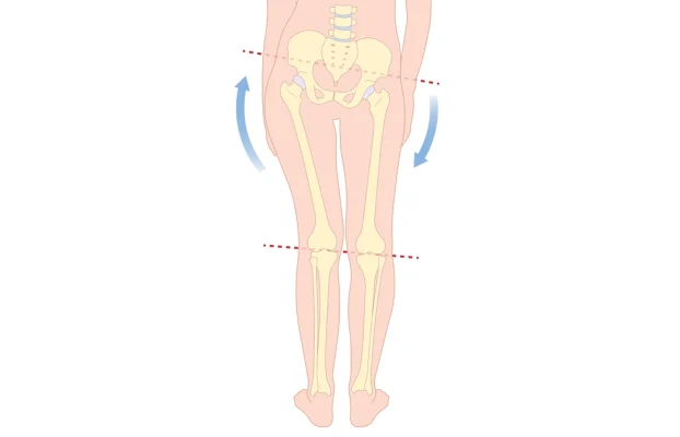 Beinlängendifferenz: Ursachen, Symptome und Behandlung