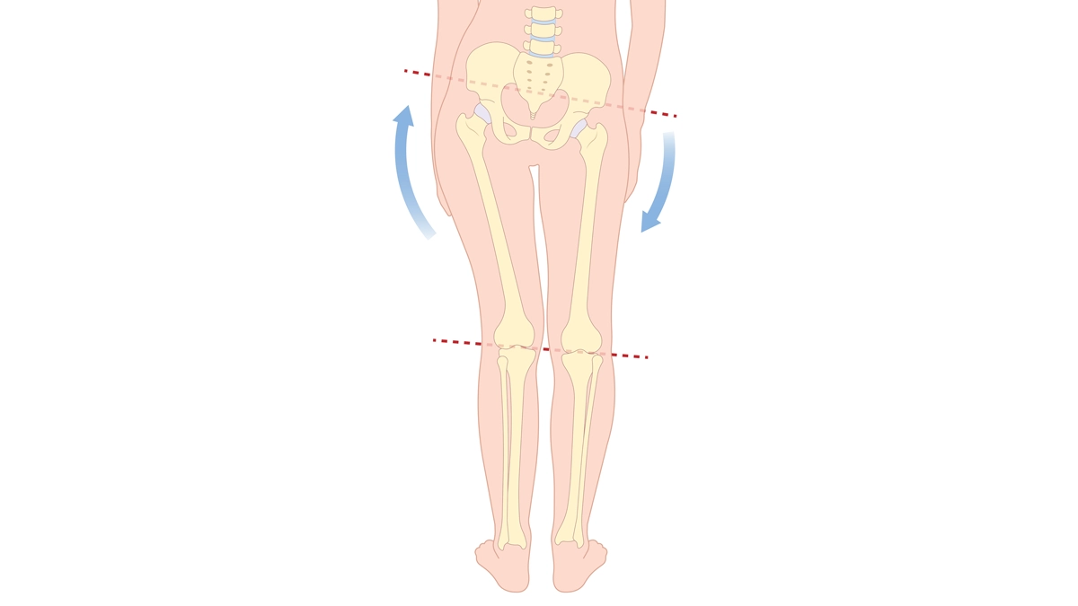 Beinlängendifferenz: Ursachen, Symptome und Behandlung