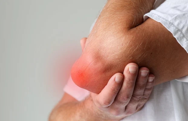 Was ist Olekranon-Bursitis?