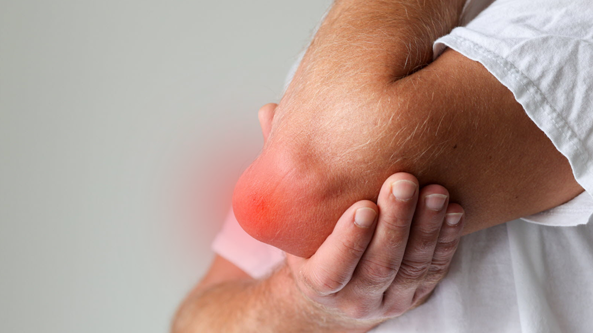 Was ist Olekranon-Bursitis?