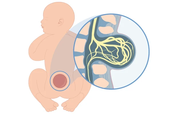 Spina Bifida: Ursachen, Auswirkungen und Behandlung