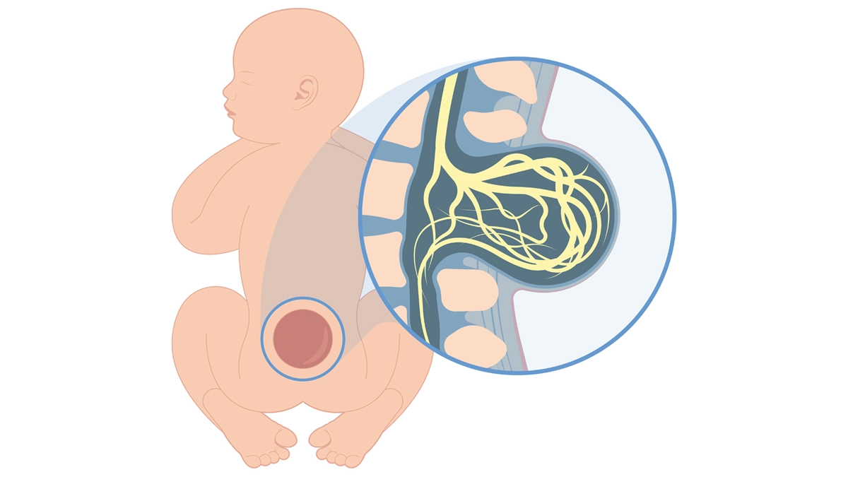 Spina Bifida: Ursachen, Auswirkungen und Behandlung